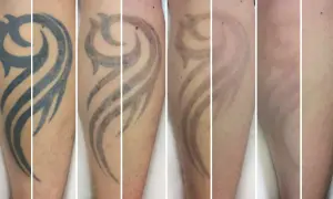 Secuencia de imágenes muestra la eliminación de un tatuaje tribal. Se observa cómo el tatuaje se desvanece con el tiempo, respondiendo a la pregunta de cuanto se tarda en quitar un tatuaje.