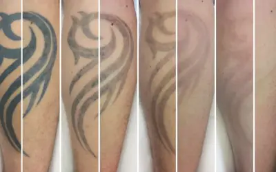 Secuencia de imágenes muestra la eliminación de un tatuaje tribal. Se observa cómo el tatuaje se desvanece con el tiempo, respondiendo a la pregunta de cuanto se tarda en quitar un tatuaje.