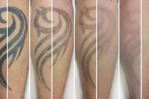 Secuencia de imágenes muestra la eliminación de un tatuaje tribal. Se observa cómo el tatuaje se desvanece con el tiempo, respondiendo a la pregunta de cuanto se tarda en quitar un tatuaje.