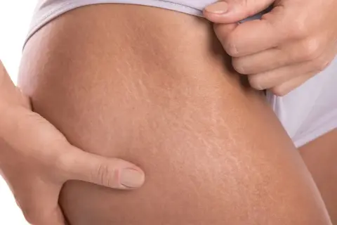 Manos acariciando piel con estrías blancas, mostrando cómo los tatuajes pueden embellecerlas.