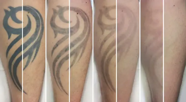 Secuencia de imágenes muestra la eliminación de un tatuaje tribal. Se observa cómo el tatuaje se desvanece con el tiempo, respondiendo a la pregunta de cuanto se tarda en quitar un tatuaje.