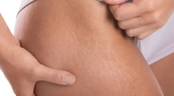 Manos acariciando piel con estrías blancas, mostrando cómo los tatuajes pueden embellecerlas.