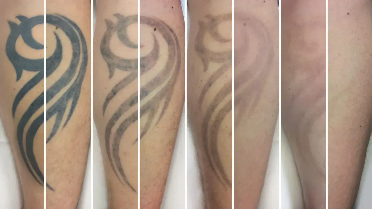 Secuencia de imágenes muestra la eliminación de un tatuaje tribal. Se observa cómo el tatuaje se desvanece con el tiempo, respondiendo a la pregunta de cuanto se tarda en quitar un tatuaje.