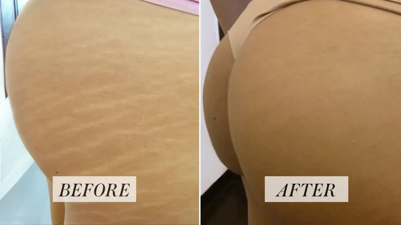 Antes y despu&eacute;s de un tratamiento para tatuajes sobre estr&iacute;as blancas. La imagen de la izquierda muestra estr&iacute;as visibles, mientras que la de la derecha revela una piel m&aacute;s uniforme.