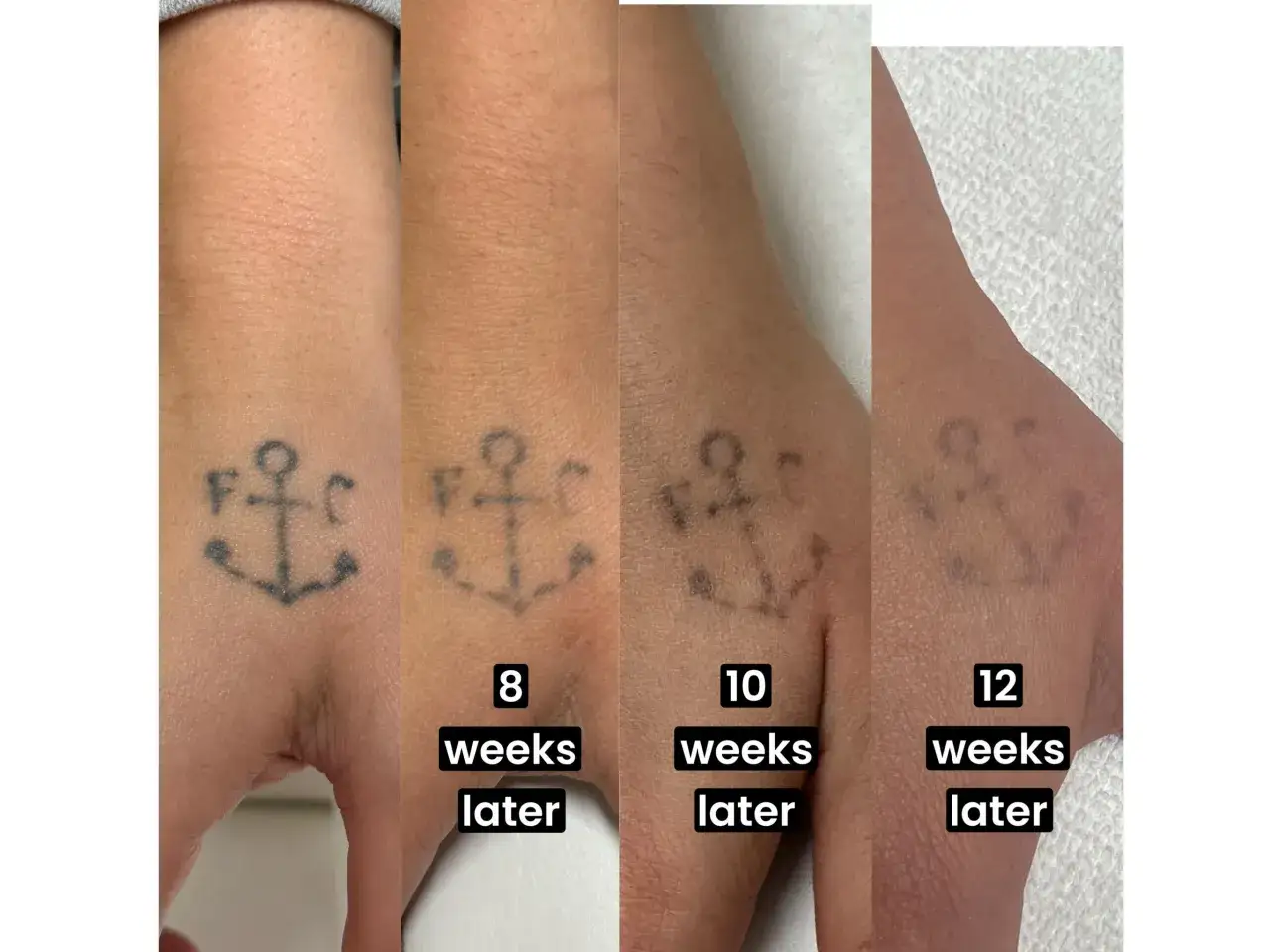 Evolución de la eliminación de un tatuaje de ancla en la mano. Muestra cómo el tatuaje se desvanece con el tiempo, indicando cuánto se tarda en quitar un tatuaje.