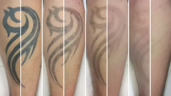 Secuencia de imágenes muestra la eliminación de un tatuaje tribal. Se observa cómo el tatuaje se desvanece con el tiempo, respondiendo a la pregunta de cuanto se tarda en quitar un tatuaje.